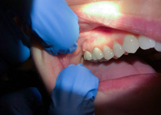 Best Emergency Wisdom Teeth Removal in Monticello, WI