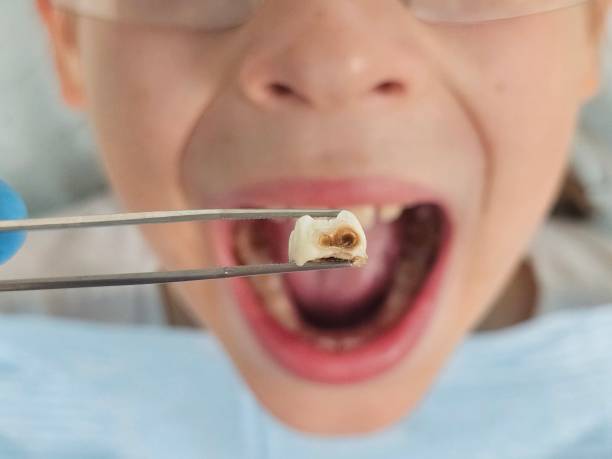 Best Emergency Tooth Extraction in Monticello, WI