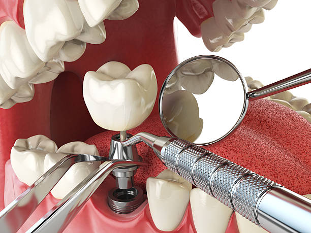 Best Emergency Dental Care for Broken or Chipped Teeth in Monticello, WI